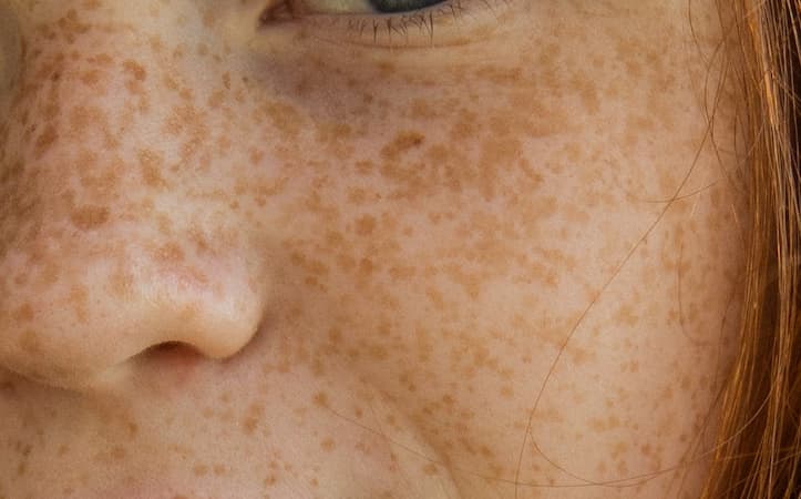 Love Your Freckles Day, Solar Lentigines